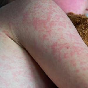 Babies exposed to measles getting preventive treatment every week in Manitoba