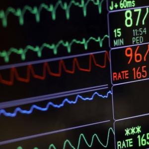 Blood thinners not needed for many with irregular heartbeat, says Canadian study