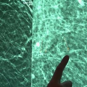 Can a mammogram help identify heart disease?