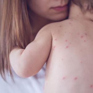 Canada lost its measles-free status. Our children deserve better