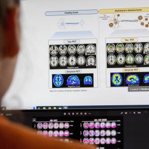 Canada's Drug Agency reverses course, now recommends public drug plans cover Alzheimer's drug