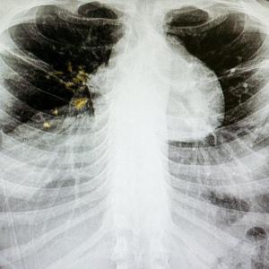 Canadian Red Cross to assist in Nunavik's fight against tuberculosis