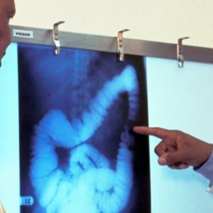 Colorectal cancer rising in younger adults as calls grow to lower screening age in Canada