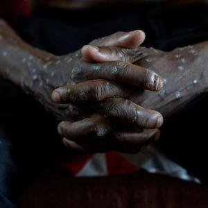 Congo says its mpox outbreak is over after 2 years and more than 2,200 suspected deaths