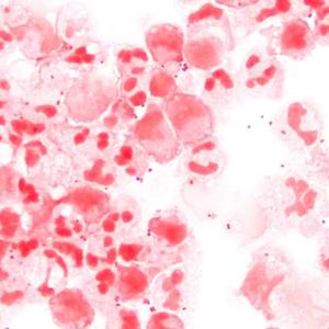 Dangerous bacterial infection hits highest level seen in Canada in more than a decade