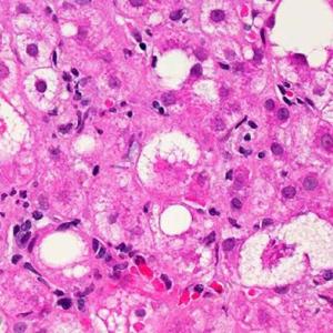 Doctors, liver specialist team up to better fight hepatitis in Alberta