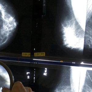 Global breast cancer cases expected to reach over 3.5 million by 2050