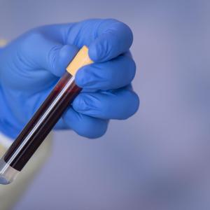 Grail's Cancer Detection Test Fails in Major Study