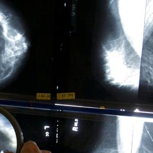 Health Canada approves drug that treats hot flashes for use by breast cancer patients