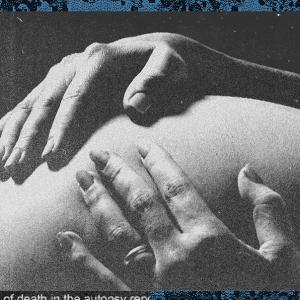 In U.S. Courts, an Unvalidated 'Lung Float Test' Is Still Used to Justify Murder Charges After Pregnancy Loss