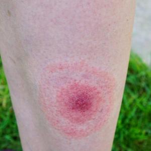 Lyme disease cases in England rise by more than 20% in a year