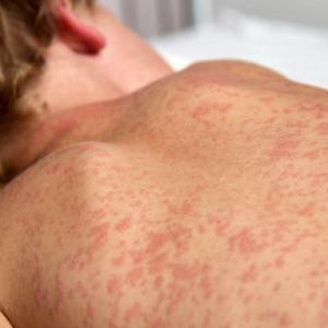 Manitoba health officials report 25 more measles cases as province remains national hotspot