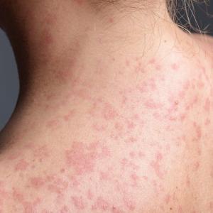 Manitoba still faces challenge in curbing measles a year into outbreak: community health prof