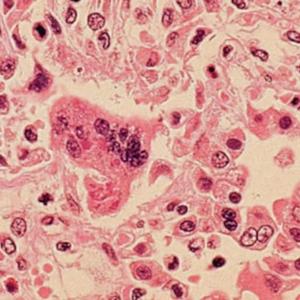 Manitoba's monthly measles number reaches three digits for the first time