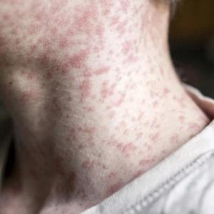 Measles exposure alert issued for Calgary airport, bus terminals around Alberta