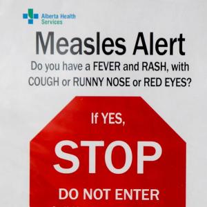 Measles exposure alert issued for Foothills, Alberta Children's Hospital emergency departments