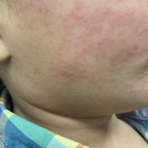 Measles goes quiet in Alberta but risk not over, experts warn