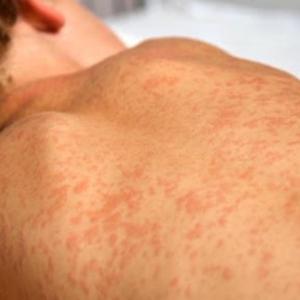 Measles outbreak expected to continue in northeast B.C. with 5 or more new cases a day, health officials say