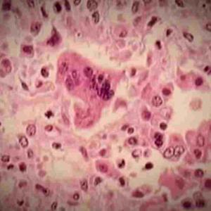 Measles outbreak in Portneuf, Que., grows to 7 cases
