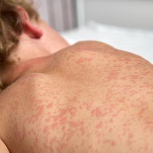 Measles vaccination rates falling provincewide, CBC analysis finds