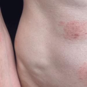 Minnesota health officials warn of sexually transmitted fungal infection outbreak