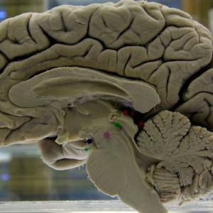 Neuropathologists urge Ottawa to bring back autopsy services for patients suspected of having fatal brain illness