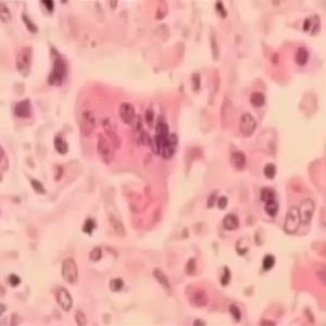 Newark Airport passenger may have exposed others to measles: NJ Health Dept