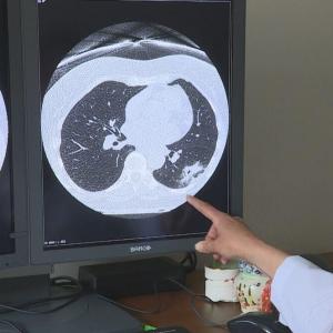 Nova Scotia's lung screening program finds dozens of cancer cases in first 2 years