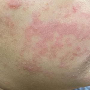 Ontario measles cases reach 2,276 as spread begins to wane