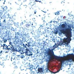 Outbreak of diarrhea caused by parasite jumps to 3,000 cases. Here’s why it’s so hard to identify the source