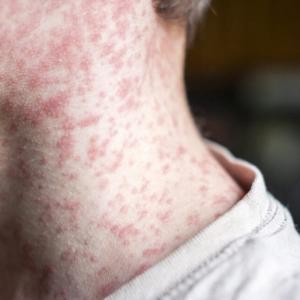 Over 250 people quarantined in South Carolina measles outbreak