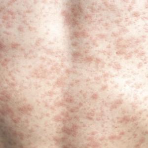 PAHO calls on Canada to do more to prevent measles