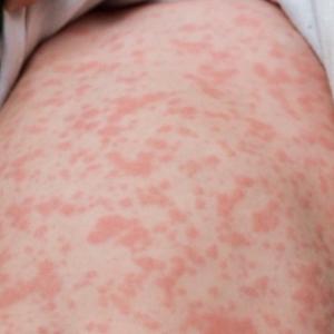 Popular Ontario summer-travel spot sees the most new measles cases for the week