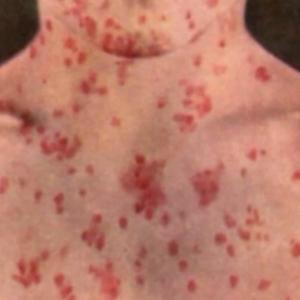 Potential measles exposures reported on 2 flights, Pearson airport: Public Health