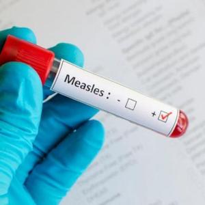 Red Deer seniors facility visitors warned of possible measles exposure