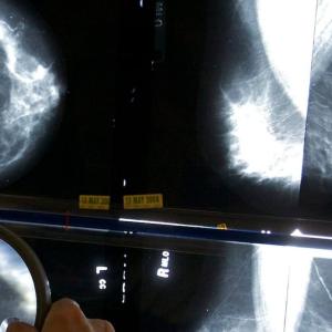 Regions in Canada that face the highest rates of breast cancer, study reveals