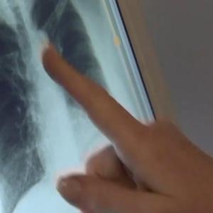 Sask. Health Authority defends tuberculosis response, management