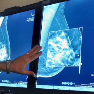 Sask. women 45+ can now self-refer for breast screening mammograms, but awareness, capacity issues continue