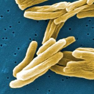 Saskatchewan has some of the highest tuberculosis rates in the country