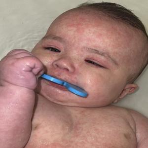 'She could have died.' Alberta mother feared the worst for 4-month-old with measles