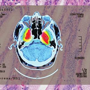 'Strong evidence' of lowered dementia risk: the benefits of shingles vaccination