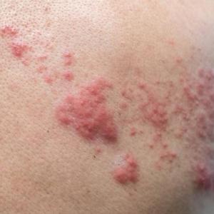 Study suggests elevated shingles risk in younger adults with chronic conditions