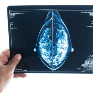 These are the Canadian regions with the highest rates of breast cancer