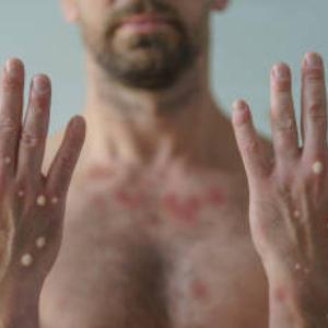 Tpoxx doesn't improve on placebo in achieving key mpox outcomes, phase 3 trial concludes