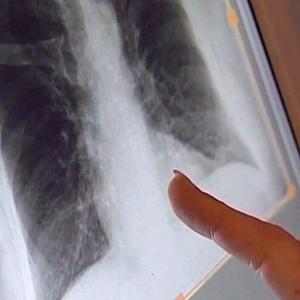 Tuberculosis cases rising in Montreal, other parts of Quebec