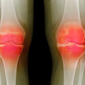 U.S. Federal Agency Unveils Three Potential Osteoarthritis Treatments