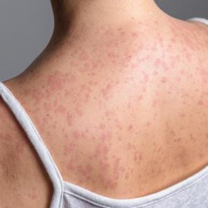 US 'highly likely' to lose measles elimination status this fall, analysis warns
