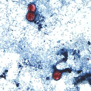 What to know about cyclosporiasis, the gastrointestinal illness outbreak hitting the U.S.