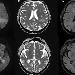You're likely already infected with a brain-eating virus you've never heard of