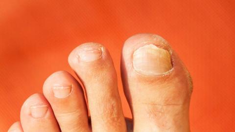 10K toenail clippings needed for Canadian study on potential lung cancer risk
